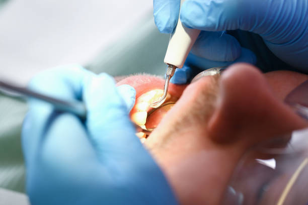 Best Emergency Dental Care for Abscessed Tooth in Memphis, TX